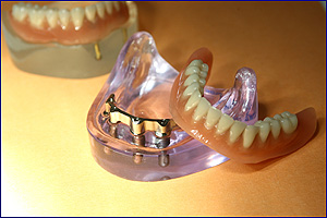 Implantatarbeit zur Befestigung von totalem Zahnersatz Implantatarbeit zur Befestigung von totalem Zahnersatz